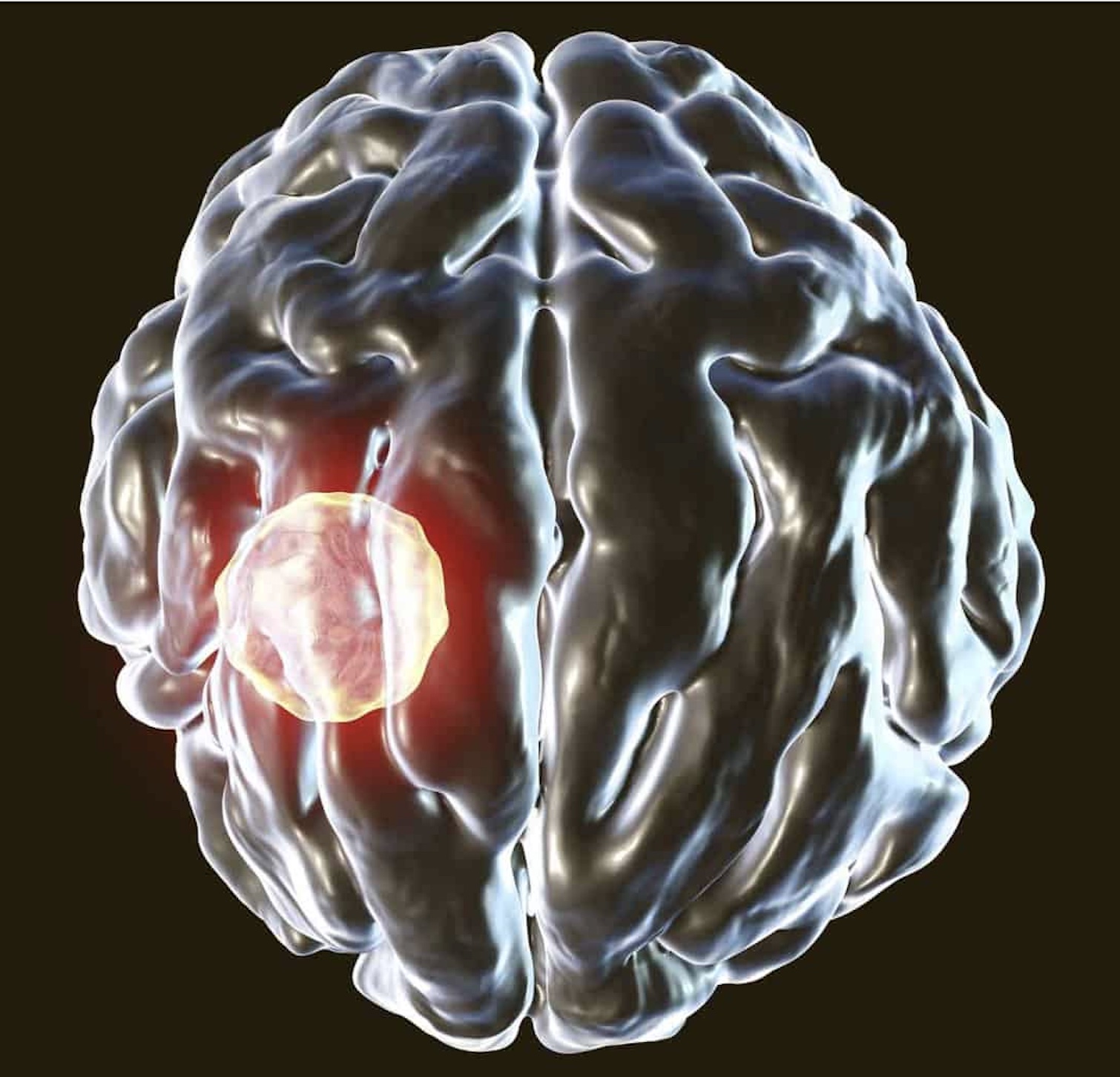 Primary Brain Abscesses – Infectious Diseases – International Research ...